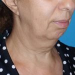 Deep Plane Lower Face & Neck Lift Before & After Patient #1041
