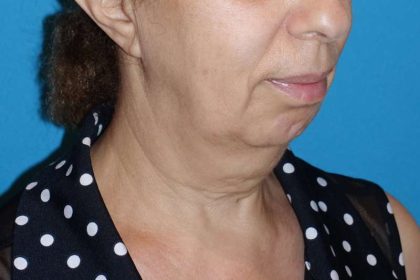 Deep Plane Lower Face & Neck Lift Before & After Patient #1041