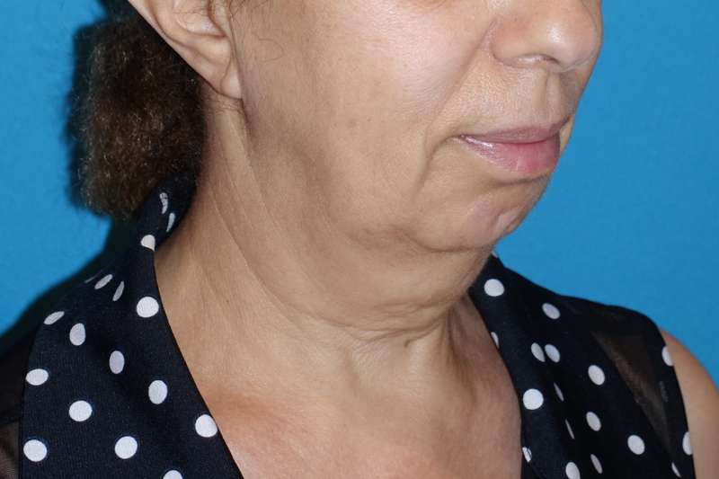 Deep Plane Lower Face & Neck Lift Before & After Patient #1041