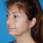 Deep Plane Lower Face & Neck Lift Before & After Patient #1052
