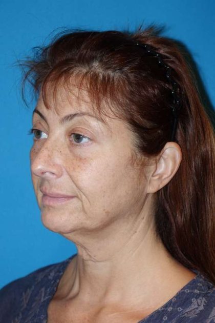 Deep Plane Lower Face & Neck Lift Before & After Patient #1052