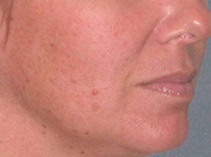 Juvéderm - Lips Before & After Patient #659