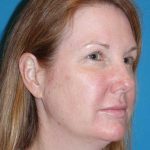 FaceTite Before & After Patient #704