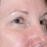 Eyelid Lift- Lower Before & After Patient #742