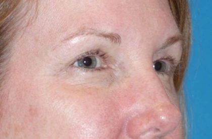 Eyelid Lift- Lower Before & After Patient #742