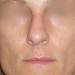 Rhinoplasty Before & After Patient #798
