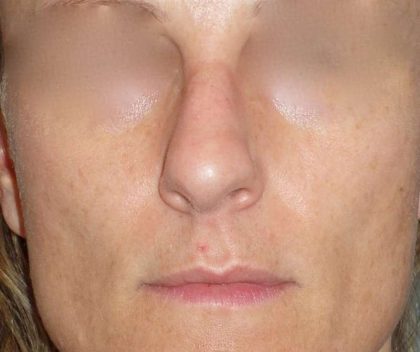 Rhinoplasty Before & After Patient #798