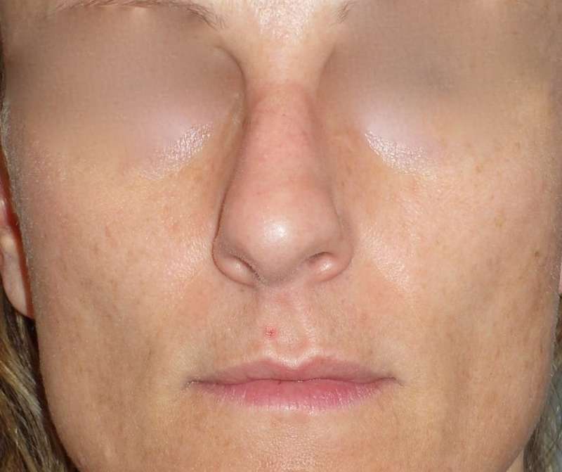 Rhinoplasty Before & After Patient #798