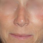 Rhinoplasty Before & After Patient #809