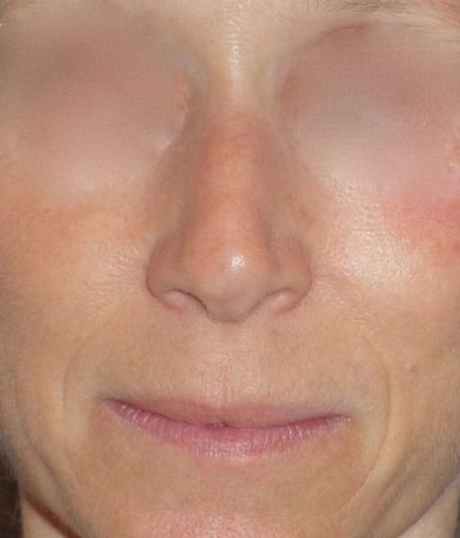 Rhinoplasty Before & After Patient #809