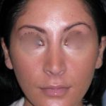 Rhinoplasty Before & After Patient #816