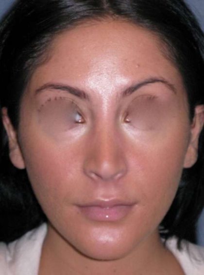 Rhinoplasty Before & After Patient #816