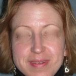 Rhinoplasty Before & After Patient #823