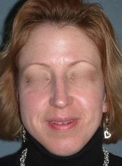 Rhinoplasty Before & After Patient #823