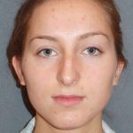 Rhinoplasty Before & After Patient #845