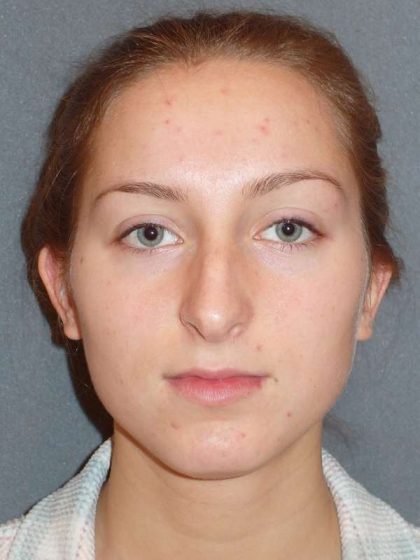Rhinoplasty Before & After Patient #845