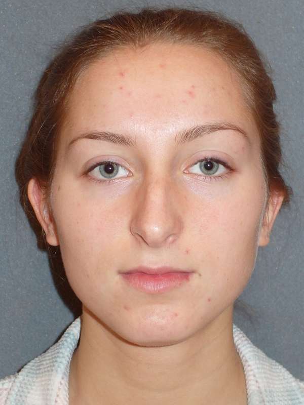 Rhinoplasty Before & After Patient #845