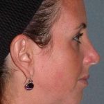 Fraxel Restore Before & After Patient #677