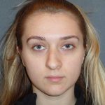 Rhinoplasty Before & After Patient #856