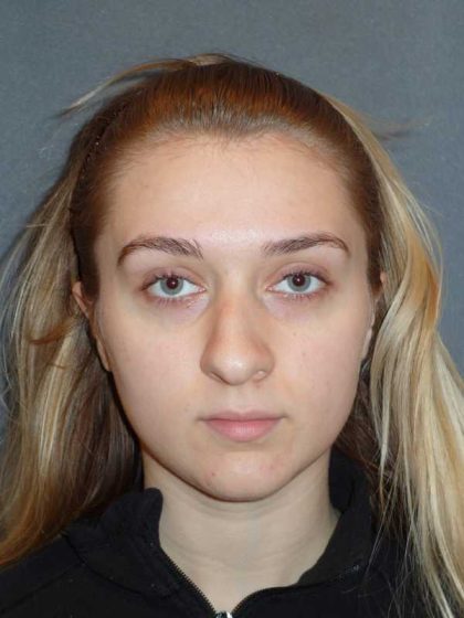 Rhinoplasty Before & After Patient #856