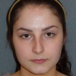 Rhinoplasty Before & After Patient #867