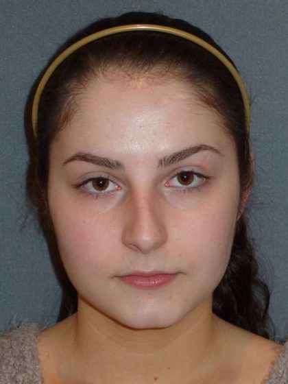 Rhinoplasty Before & After Patient #867