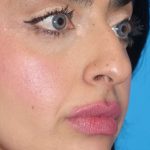 Rhinoplasty Before & After Patient #887
