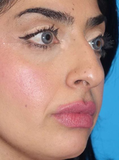 Rhinoplasty Before & After Patient #887