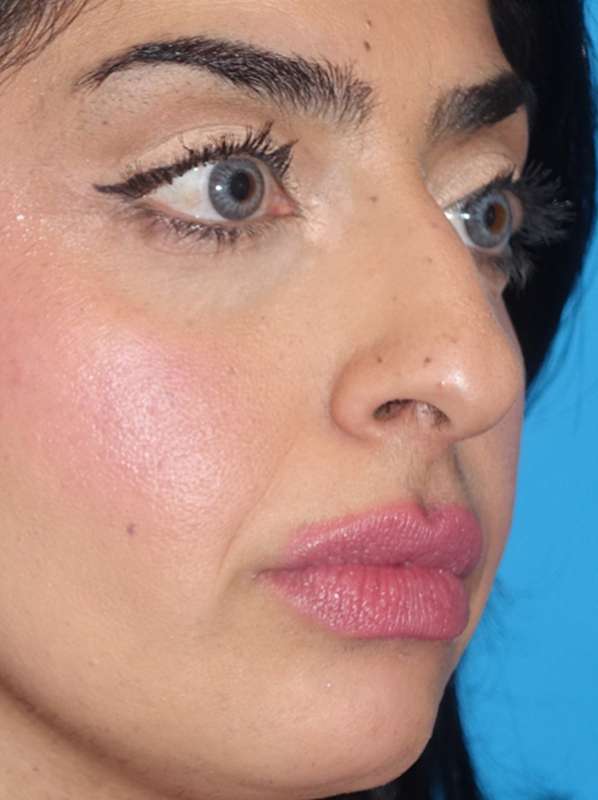 Rhinoplasty Before & After Patient #887