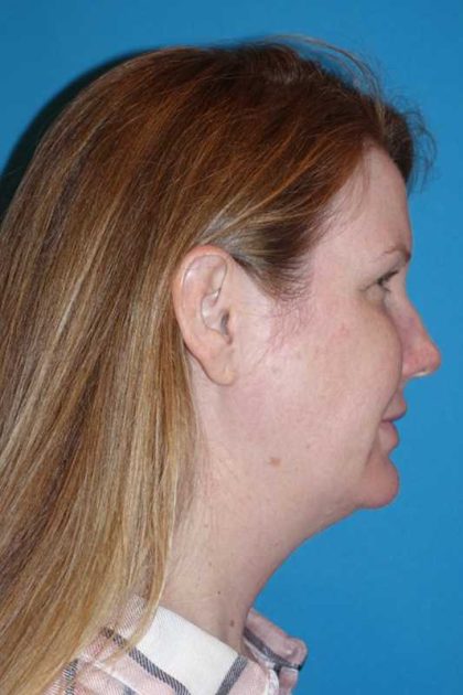 FaceTite Before & After Patient #704