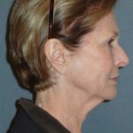 Deep Plane Lower Face & Neck Lift Before & After Patient #920