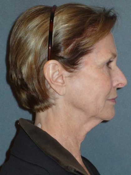 Deep Plane Lower Face & Neck Lift Before & After Patient #920