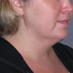 Deep Plane Lower Face & Neck Lift Before & After Patient #947
