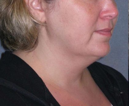Deep Plane Lower Face & Neck Lift Before & After Patient #947