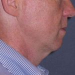 Deep Plane Mini Lift & Neck Lift Before & After Patient #965
