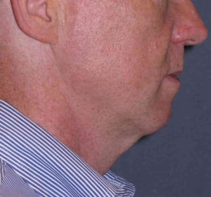 Deep Plane Mini Lift & Neck Lift Before & After Patient #965