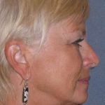 Deep Plane Mini Lift & Neck Lift Before & After Patient #972