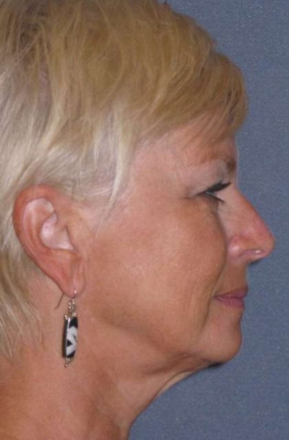 Deep Plane Mini Lift & Neck Lift Before & After Patient #972