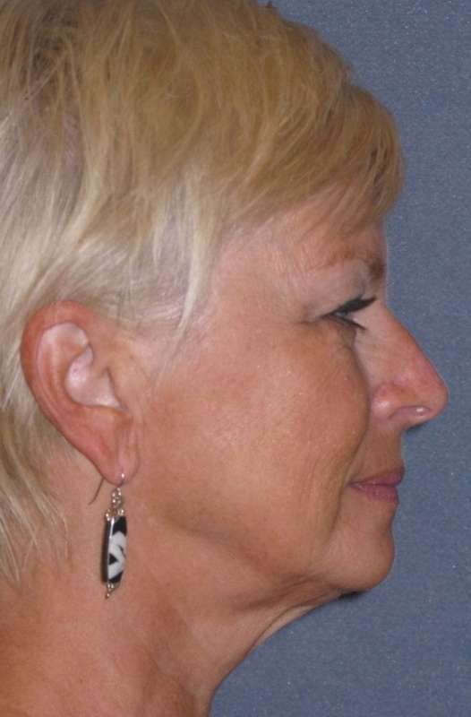 Deep Plane Mini Lift & Neck Lift Before & After Patient #972