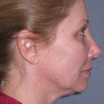 Deep Plane Mini Lift & Neck Lift Before & After Patient #981