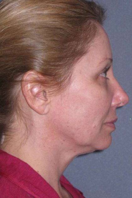 Deep Plane Mini Lift & Neck Lift Before & After Patient #981