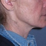 Deep Plane Mini Lift & Neck Lift Before & After Patient #988