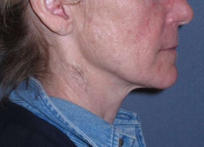Deep Plane Mini Lift & Neck Lift Before & After Patient #988