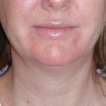 Neck Lift Before & After Patient #1018