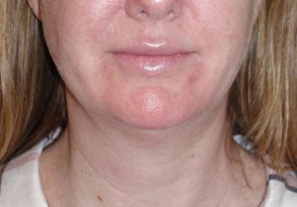 Neck Lift Before & After Patient #1018