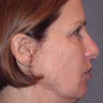 Deep Plane Mini Lift & Neck Lift Before & After Patient #1030