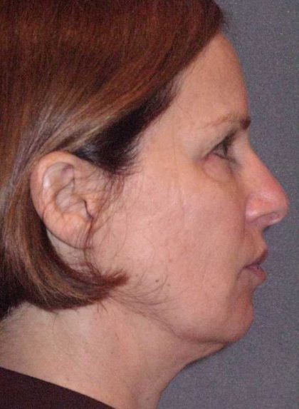 Deep Plane Mini Lift & Neck Lift Before & After Patient #1030