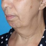 Deep Plane Lower Face & Neck Lift Before & After Patient #1041