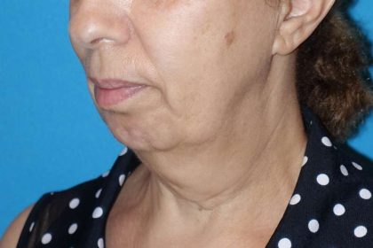Deep Plane Lower Face & Neck Lift Before & After Patient #1041