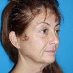 Deep Plane Lower Face & Neck Lift Before & After Patient #1052